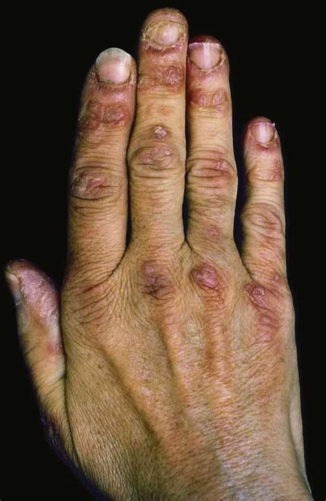 Dermatologic Signs Of Systematic Disease Disease Autoimmune Disease