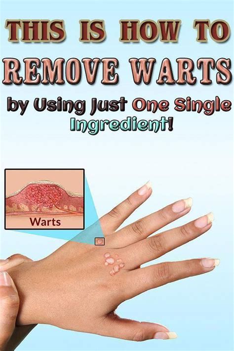 Pin On Home Remedies For Warts On Finger