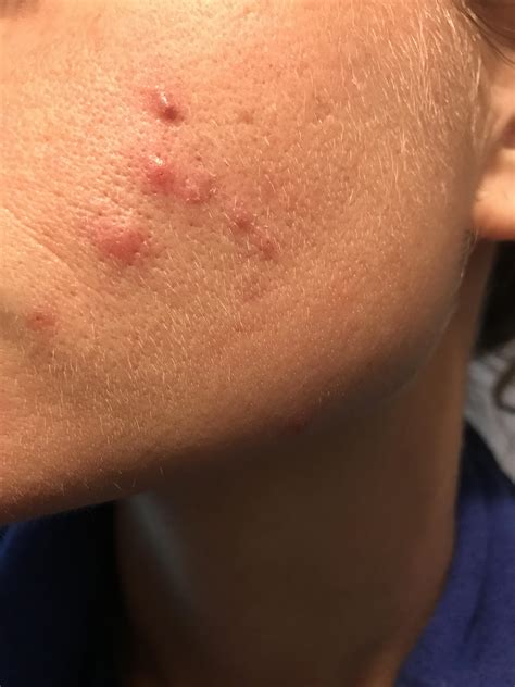 Pimples On Right Cheek Only Acne Symptoms