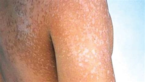 What To Know About Pityriasis Versicolor Skin Infection The