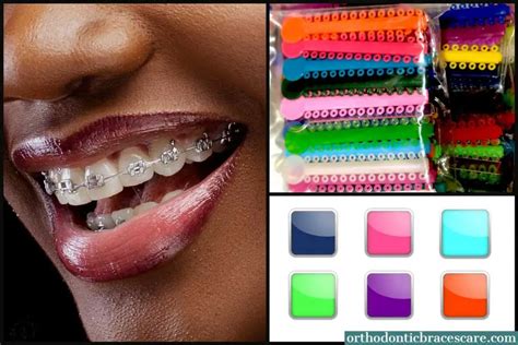 Best Braces Colors For Dark Skin How To Choose Orthodontic Braces Care