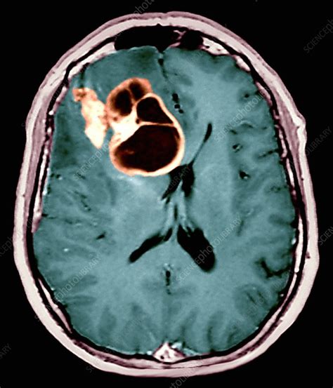 Brain Cancer Mri Scan Stock Image M1340469 Science Photo Library