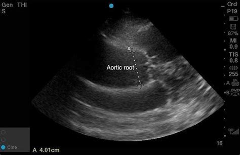 Cureus Transthoracic Echocardiographic Findings Of Stanford Type A