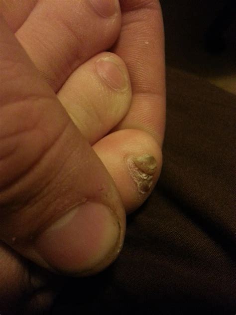 Why Is My Pinky Toenail Thick Ethel Bailey Blogs