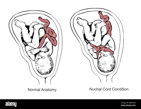 cordón nucal y asphyxia de nacimiento ilustración fotografía de stock alamy
