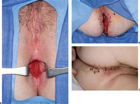 RECONSTRUCTION OF THE PERINEUM Grabb And Smith S Plastic Surgery