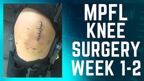 Mpfl Reconstruction Knee Surgery Recovery Youtube