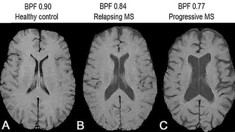 Mri For Multiple Sclerosis Diagnosis Multiple Sclerosis Mri Brain