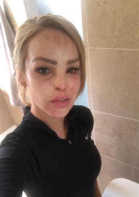 Katie Piper Fully Recovered After She Had Acid Thrown In Her Face Demotix