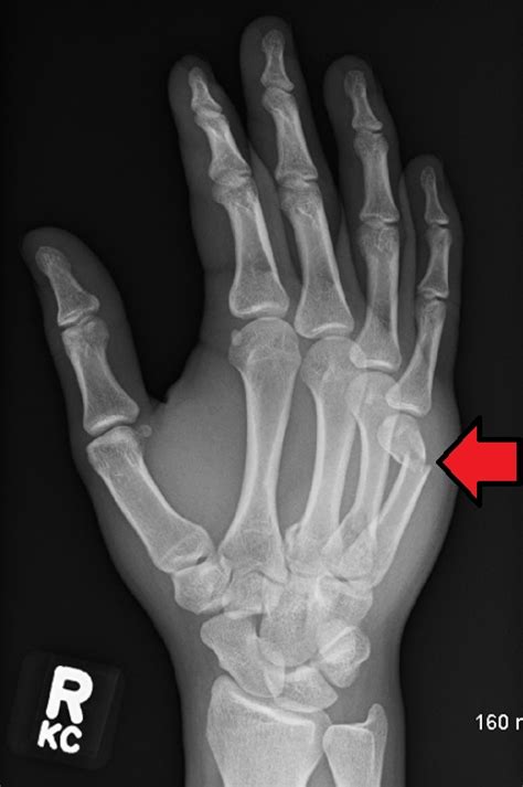 Boxer S Fracture Wikem