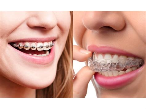 Top benefits of wearing invisible braces - Ridgetop Dental International