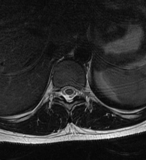 Normal Thoracic Spine Mri Image
