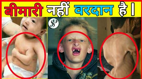 10 Disease That Gives Superpowers Scientific Nitin Youtube