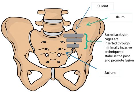 Minimally Invasive Sacroiliac Joint Fusion Dr Yu Chao Lee