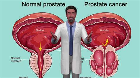 Preventing Prostate Cancer Mens Health Doctor Near Me