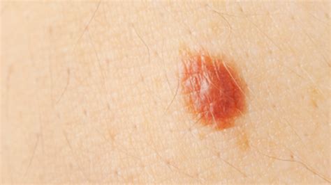 The Abcdes Of Melanoma Skin Cancer Health Choices First