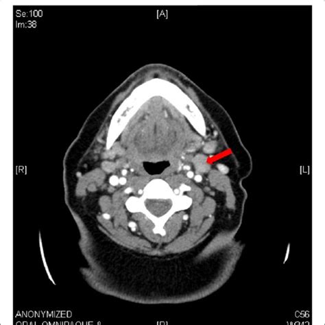 Ct Of Neck Demonstrating Bilateral Diffuse Lymphadenopathy With The