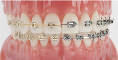 Cheap Braces What Are Your Risks De Pacific Dental Group