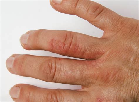 New Psoriatic Arthritis Guidelines Recommend Tnfi As First Line Tx