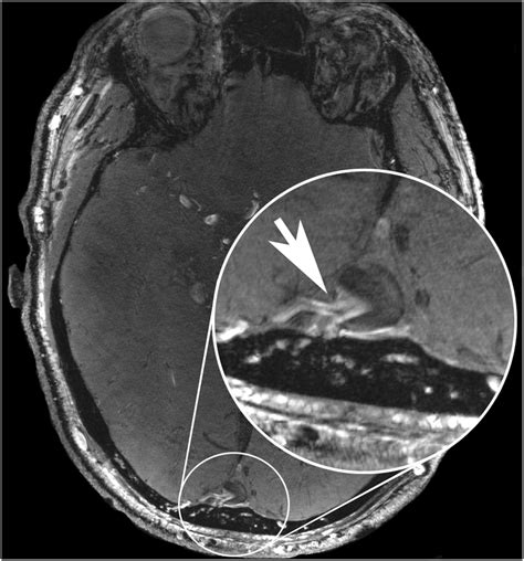 This Figure Shows The Scan Of A 58 Year Old Male Patient Subject 11