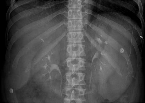 Enlarged Spleen X Ray