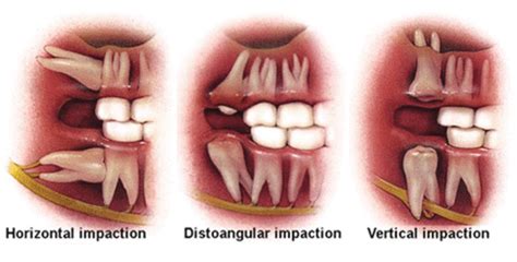 The time you can expect to spend soft foods are best. Wisdom Teeth: Preventing and Treating Infection | HubPages