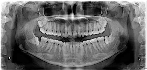 Radiologí­a Dental Digital Dento Metric Radiología Dental Oral Y
