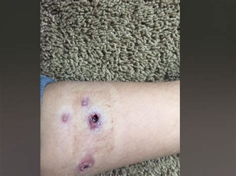 Unexplained Sores On 12 Year Old Girls Legs Tied To Pedicure Doctors