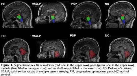 Automated Quantitative MRI Biomarkers In Differentiation Of Progressive