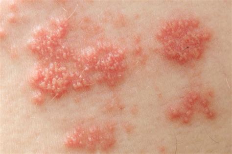 Shingles may lead to stroke and heart attack