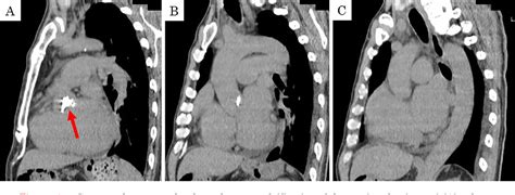 Figure 1 From An Adult Case Of Unicommissural Unicuspid Aortic Valve