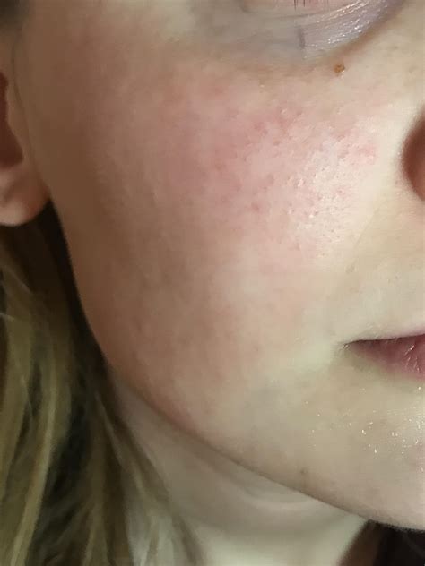 Thoughts On If This Looks Like Mild Rosacea Rosacea