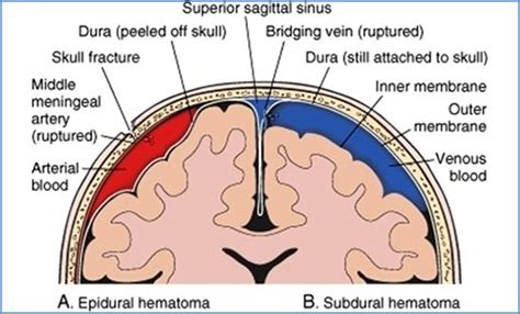 Neuroanatomy meningeal structure EDH vs SDH vs SAH 네이버 블로그