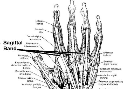 Hand Surgical Associates Boston Sagittal Band Rupture