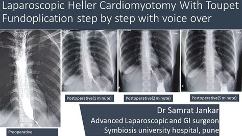 Laparoscopic Heller Myotomy With Toupet Fundoplication With Voice Over