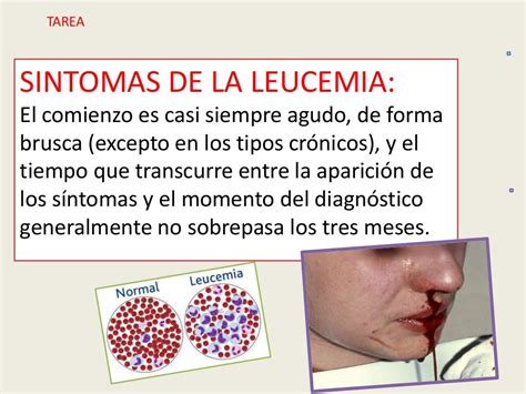 Leucemia Sintomas Leucemia Síntomas ⊛ ¡prevención Y Tratamiento 2020