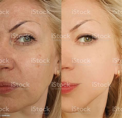 Woman Face Wrinkles Before And After Treatment Stock Photo Download