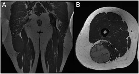Large Schwannoma Of The Sciatic Nerve Bmj Case Reports