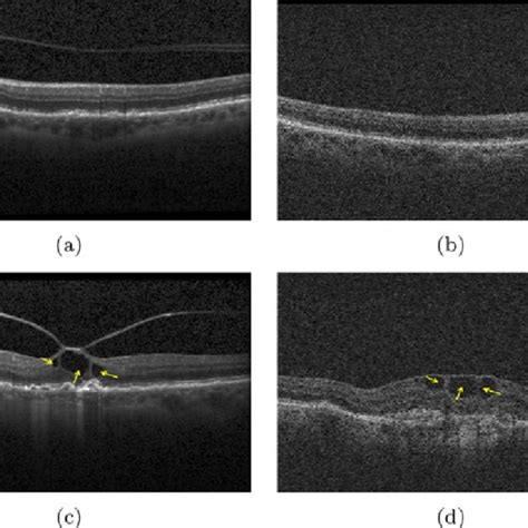 Oct Image Of Retina From Two Different Vendors Ab Normal Retina
