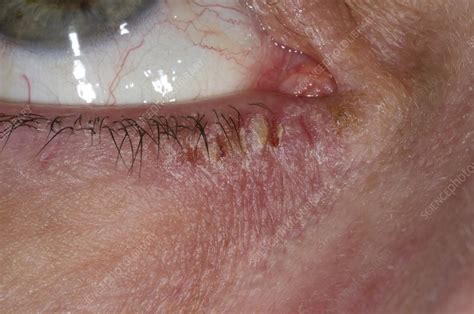 Eczema Around The Eye Stock Image C0150364 Science Photo Library