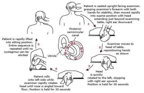 Epley Maneuver Procedure Instructions Diagram And Video