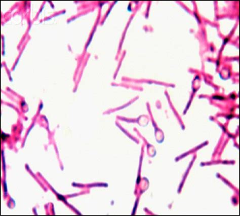 Terminal Bulging Spores Of Clostridium Tetani Medical Laboratories