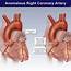 Anomalous Right Coronary Artery  TrialExhibits Inc