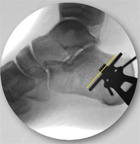Minimally Invasive Osteotomies Of The Calcaneus Foot And Ankle Clinics