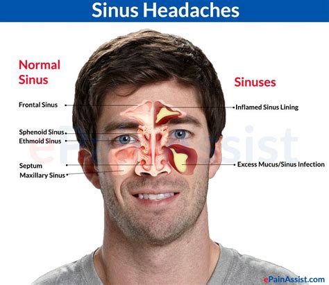 Sphenoid Sinusitis Symptoms Headache Headache