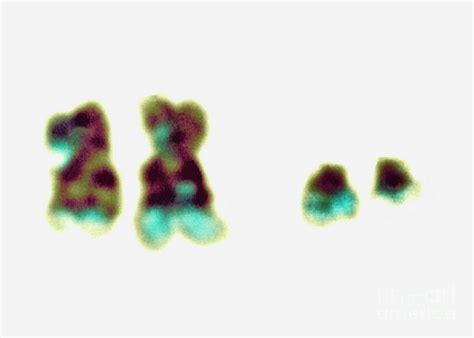 Philadelphia Chromosome Photograph By Dept Of Clinical Cytogenetics Addenbrookes Hospital