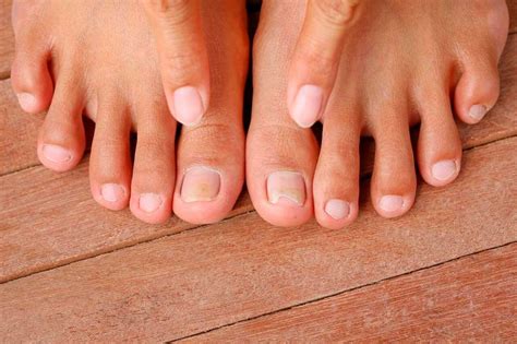 10 Best Essential Oils For Toenail Fungus With Recipes Updated