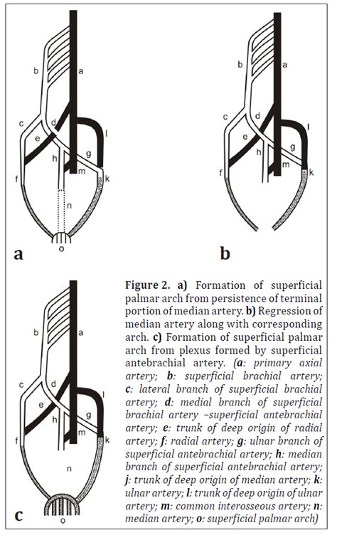 Subcutaneous Superficial Palmar Arch An Unusual Variant