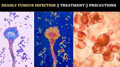 What Is Deadly Fungal Infection Treatment Of Candida Auris Youtube