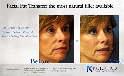 Fat Transfer San Diego Dr Kolstad San Diego Facial Plastic Surgeon